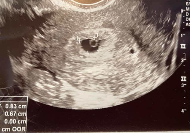 12-Week Rule Ultrasound